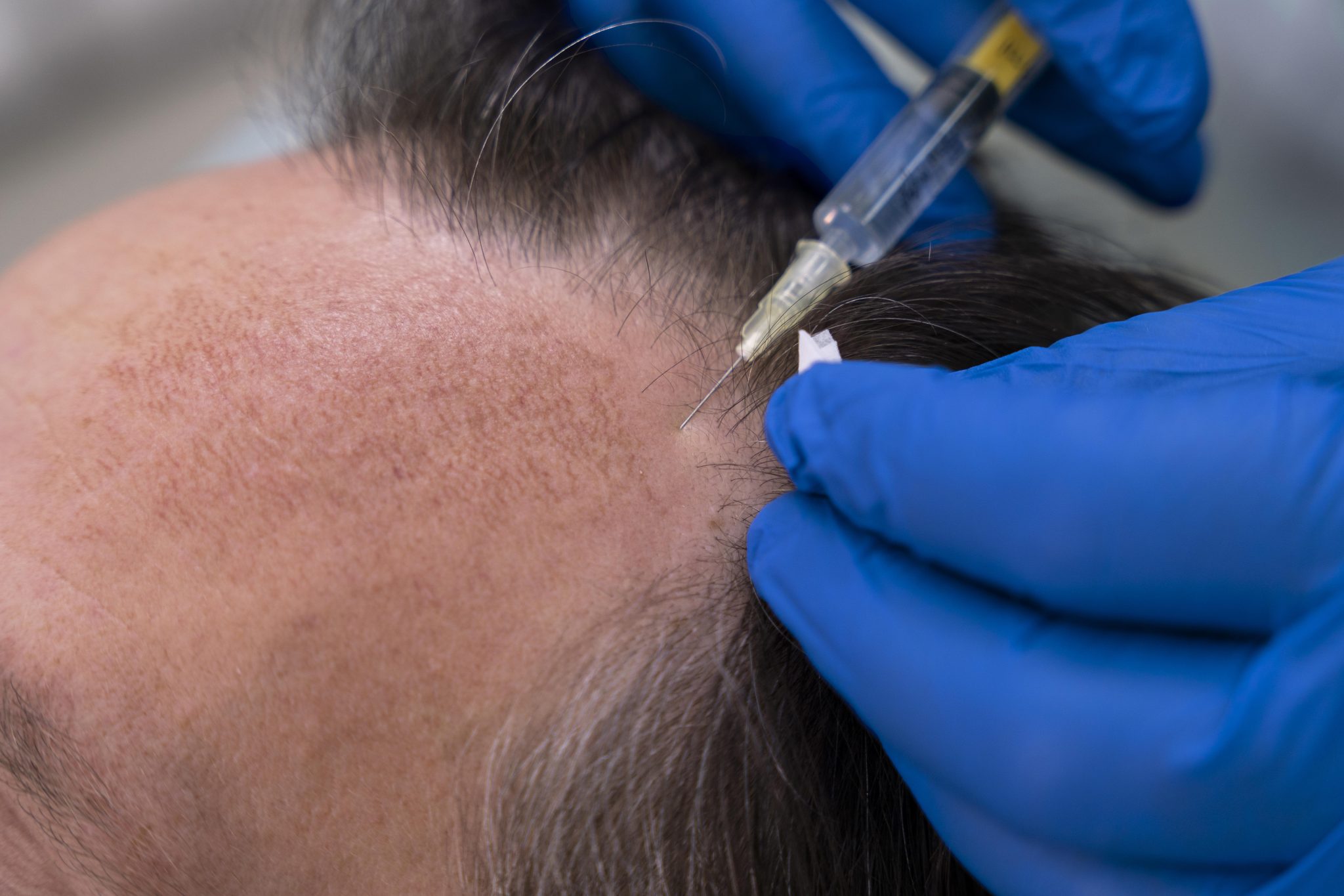 Intradermoterapia: Tipos e Principais Técnicas